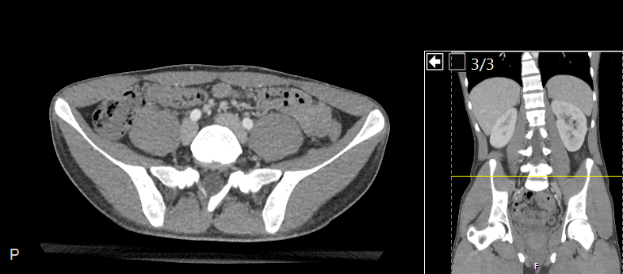 Eine CT-Aufnahme des Abdomens eines Patienten, die auf einem Computermonitor angezeigt wird und einen Bruch in der Mitte des Abdomens zeigt, wahrscheinlich eine Hysterosalpingographie, mit detaillierten Ansichten von inneren Organen und Strukturen.